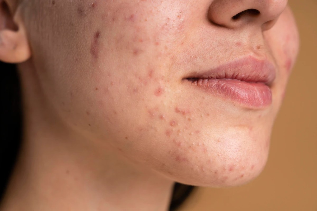 What’s Pores and skin Most cancers? – Varieties, Signs, and Its Therapy