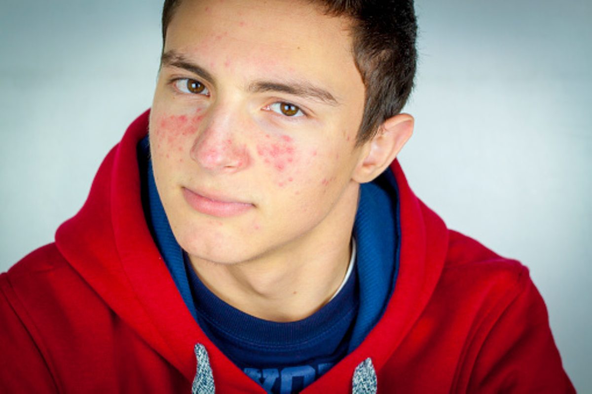 5 Factors That Affect Acne Breakouts in Teens
