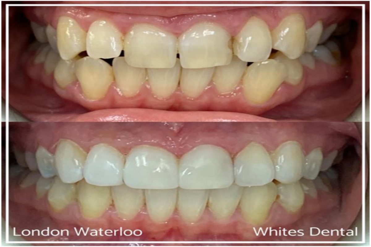 Do you have to brush veneers?