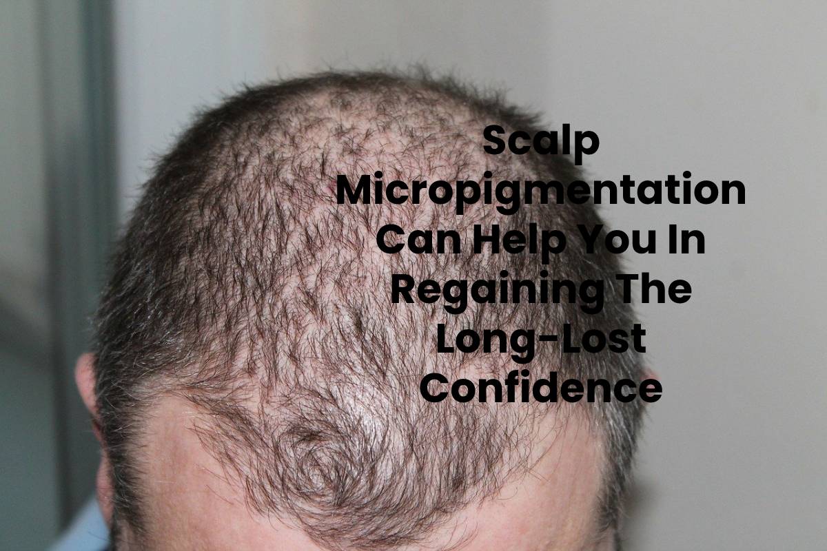 Scalp Micropigmentation Can Help You In Regaining The Long-Lost Confidence