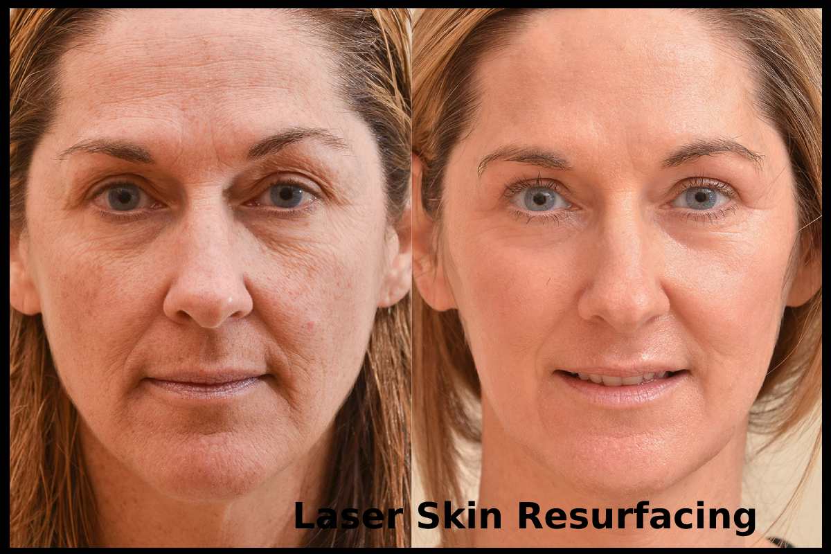 Laser Skin Resurfacing: Things You Need To Know