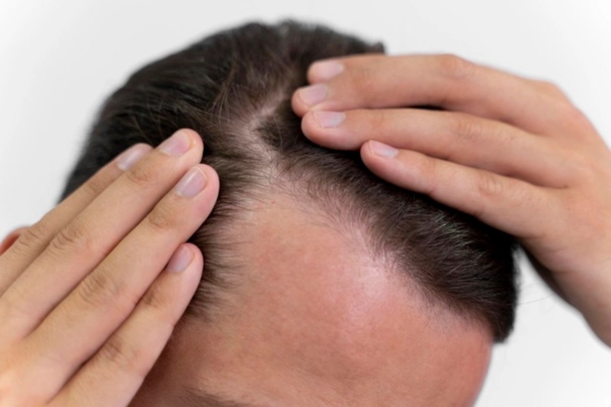 Can folks with diabetes have hair transplantation?