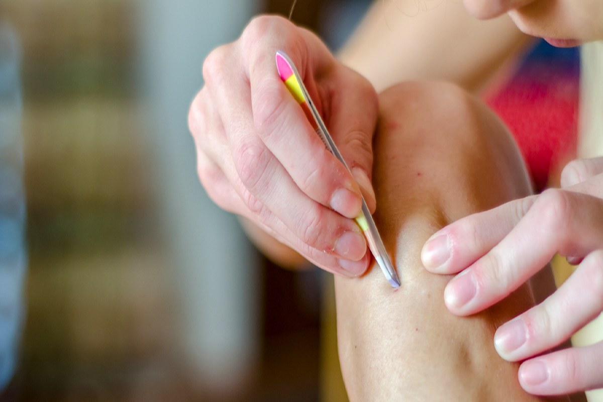 7 Ways to Deal With Ingrown Hairs