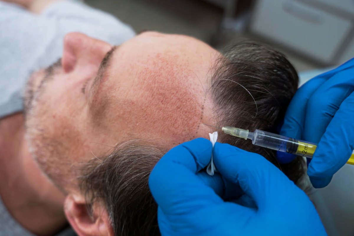 What to Count on from a Hair Transplant Earlier than and After?